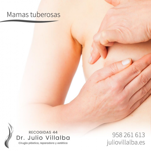 Mamas tuberosas Granada